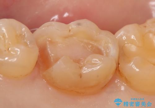 セラミックインレー 銀歯を白くの治療中