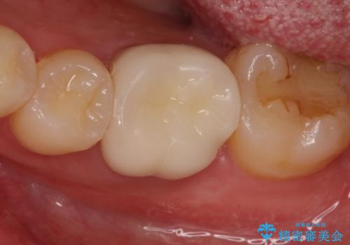 銀歯を白くしたい セラミッククラウンの治療後
