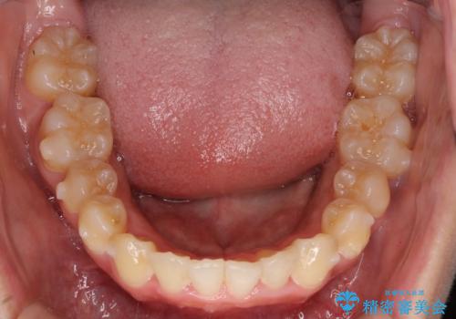 前歯のガタガタを目立たない装置でなおしたい　インビザラインによる目立たない矯正の治療中