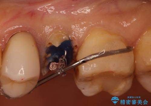 歯肉の中までの深い虫歯 部分矯正後のセラミック治療の治療前