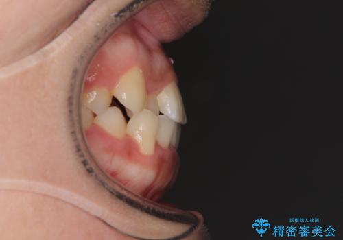 前歯の反対咬合 非抜歯のワイヤー矯正の治療前