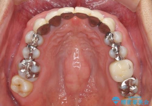 飛行機を利用しての通院 気になる所を全て治療する総合歯科治療の治療前