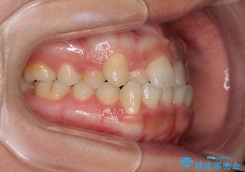 前歯の反対咬合 非抜歯のワイヤー矯正の治療前