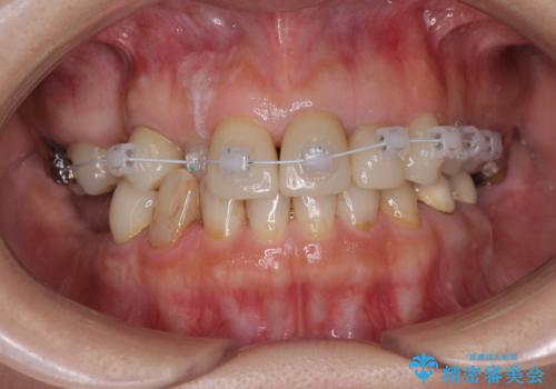 セラミックと矯正を併用してきれいな前歯への治療前