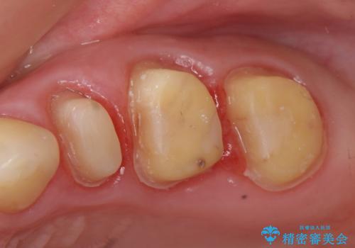 オールセラミッククラウン 根管治療後の補綴の治療中