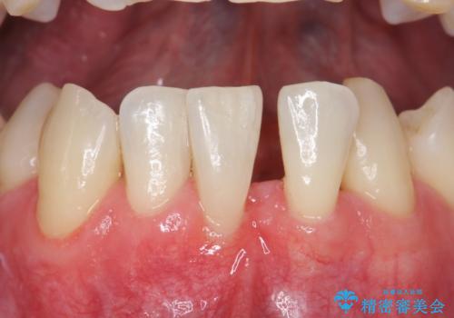 歯肉移植　矯正前の歯肉退縮の改善および予防の治療後