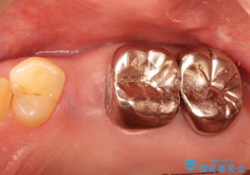 小臼歯部のインプラントの治療前