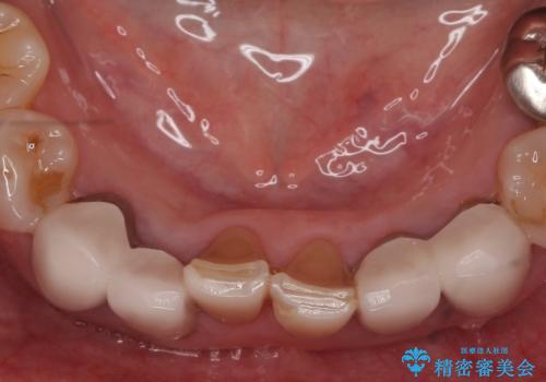 オールセラミッククラウン 前歯部の見た目の改善の治療前