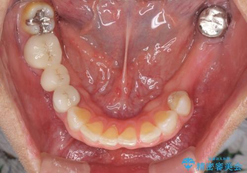 飛行機を利用しての通院 気になる所を全て治療する総合歯科治療の治療前
