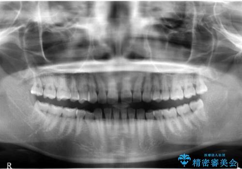 前歯のすきま　右上の小臼歯の垂直的骨吸収を抜歯で解決の治療前