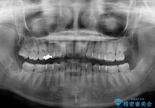 海外転居前に気になる前歯を整えたい　上下前歯の部分矯正の治療前
