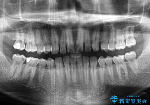 インビザラインによる、すきっ歯の改善の治療前
