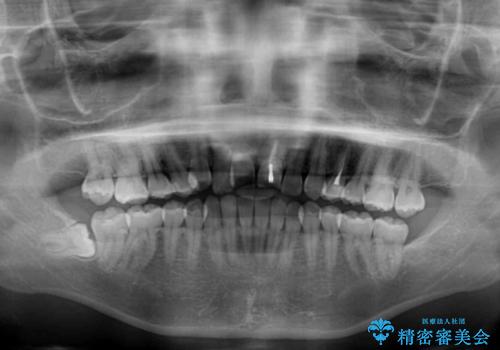 前歯の反対咬合 非抜歯のワイヤー矯正の治療前