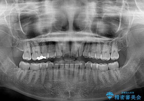 海外転居前に気になる前歯を整えたい　上下前歯の部分矯正の治療後