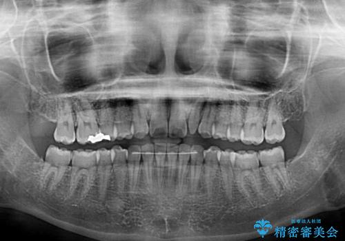 海外転居前に気になる前歯を整えたい 上下前歯の部分矯正の治療後
