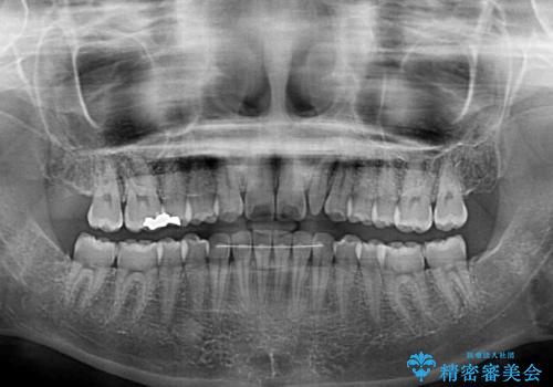 インビザラインによる、すきっ歯の改善の治療後