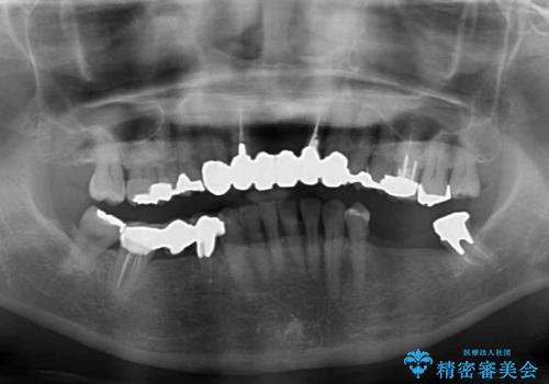 飛行機を利用しての通院 気になる所を全て治療する総合歯科治療の治療前