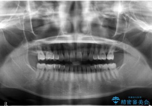 前歯のすきま　右上の小臼歯の垂直的骨吸収を抜歯で解決の治療後