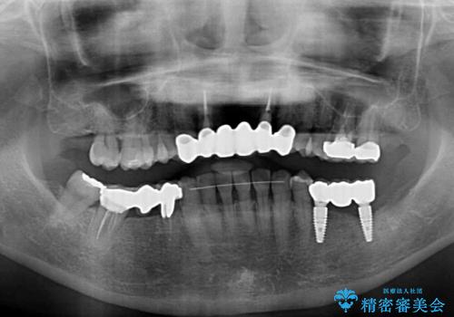 飛行機を利用しての通院 気になる所を全て治療する総合歯科治療の治療後