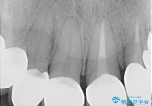 セラミックと矯正を併用してきれいな前歯への治療後