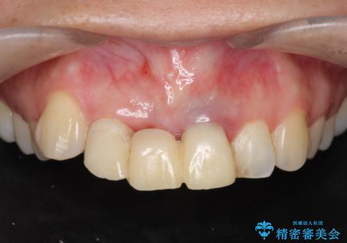 仮歯のまま放置してしまった　審美を改善したいの症例 治療前