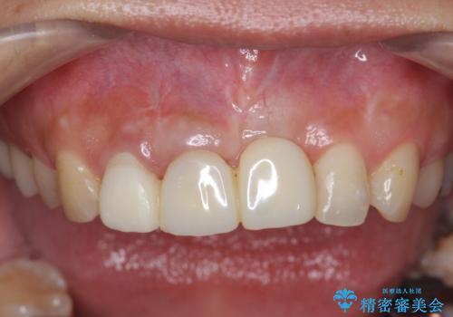 不良インプラントの除去・骨造成・歯肉移植・前歯審美セラミックブリッジ製作の治療前