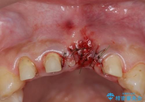 不良インプラントの除去・骨造成・歯肉移植・前歯審美セラミックブリッジ製作の治療前