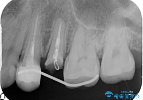 歯肉の中までの深い虫歯 部分矯正後のセラミック治療の治療中