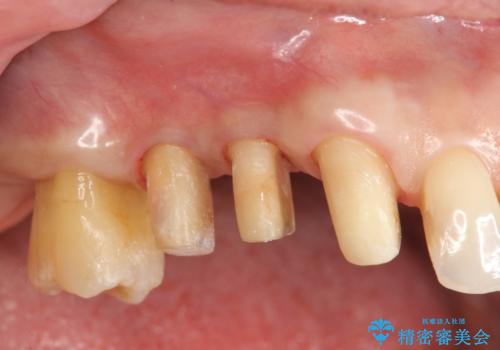 部分矯正を含む　歯周病治療 (再生治療・歯周ポケット除去・MTM・連結補綴)の治療前