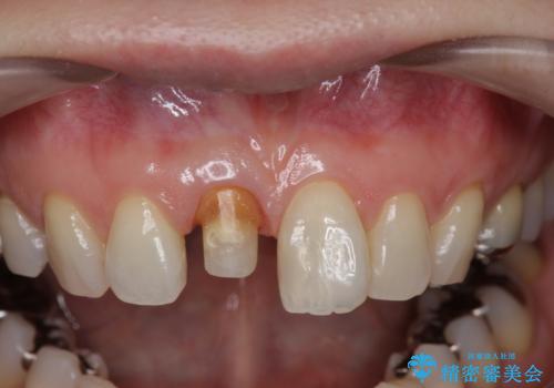 前歯の変色 セラミック審美補綴の治療中