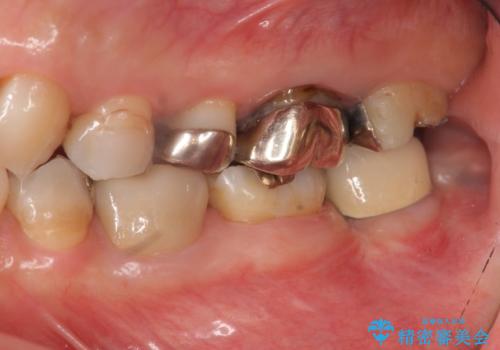 歯の破折による抜歯 インプラントによる咬合機能回復の治療後