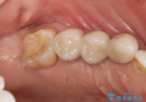 部分矯正を含む 歯周病治療 (再生治療・歯周ポケット除去・MTM・連結補綴)の治療後