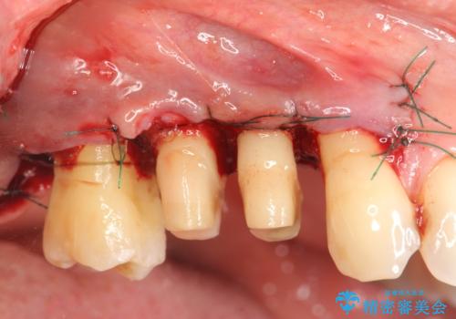 部分矯正を含む 歯周病治療 (再生治療・歯周ポケット除去・MTM・連結補綴)の治療前