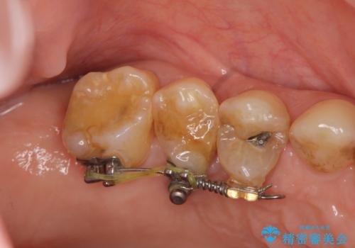 部分矯正を含む　歯周病治療 (再生治療・歯周ポケット除去・MTM・連結補綴)の治療前