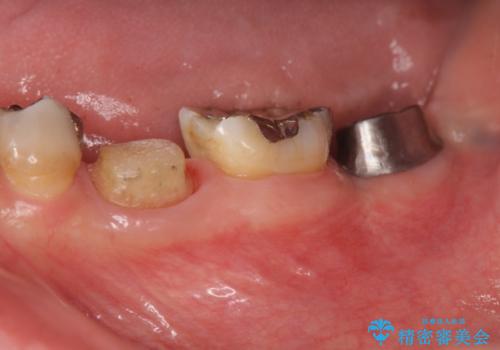 歯の破折による抜歯 インプラントによる咬合機能回復の治療中