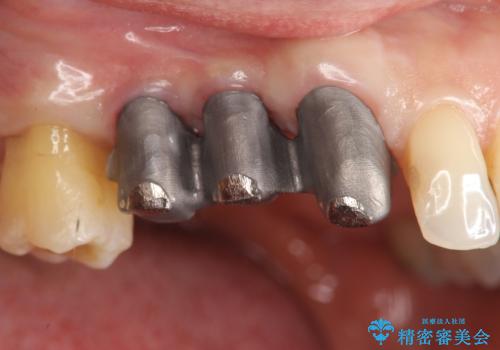 部分矯正を含む 歯周病治療 (再生治療・歯周ポケット除去・MTM・連結補綴)の治療前