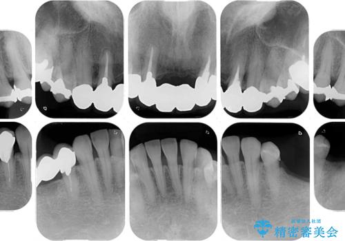 飛行機を利用しての通院 気になる所を全て治療する総合歯科治療の治療前
