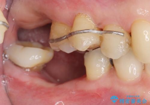 部分矯正を含む 歯周病治療 (再生治療・歯周ポケット除去・MTM・連結補綴)の治療前