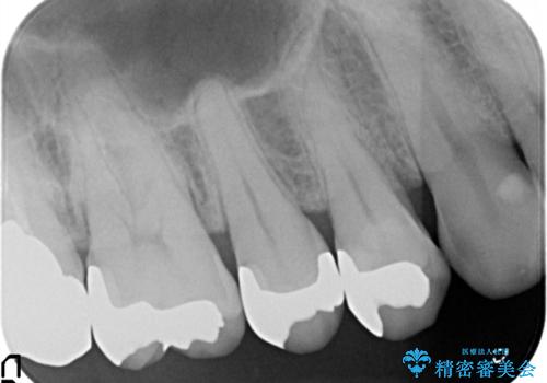 精密なむし歯の治療 ゴールドインレーの治療後