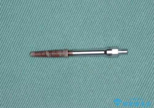 不良インプラントの除去・骨造成・歯肉移植・前歯審美セラミックブリッジ製作の治療後