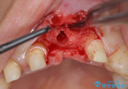 不良インプラントの除去・骨造成・歯肉移植・前歯審美セラミックブリッジ製作の治療前