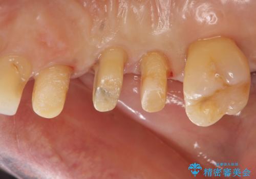 部分矯正を含む　歯周病治療 (再生治療・歯周ポケット除去・MTM・連結補綴)の治療後