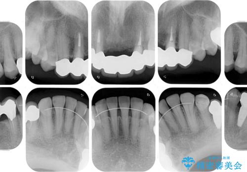 飛行機を利用しての通院 気になる所を全て治療する総合歯科治療の治療後