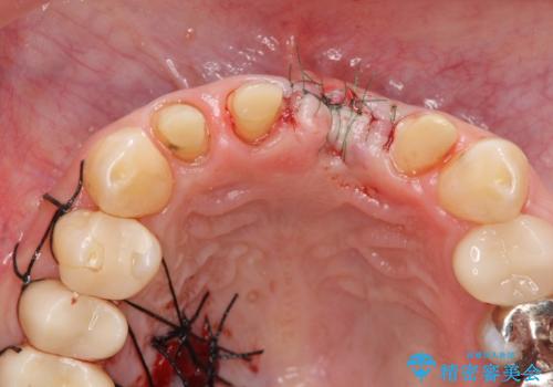 不良インプラントの除去・骨造成・歯肉移植・前歯審美セラミックブリッジ製作の治療後