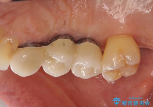部分矯正を含む 歯周病治療 (再生治療・歯周ポケット除去・MTM・連結補綴)の治療後