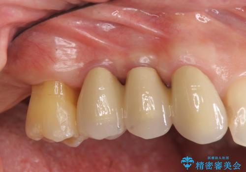 部分矯正を含む 歯周病治療 (再生治療・歯周ポケット除去・MTM・連結補綴)の症例 治療後