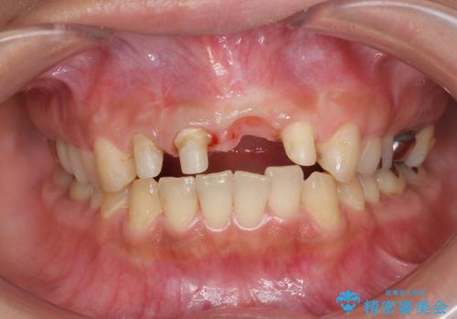 不良インプラントの除去・骨造成・歯肉移植・前歯審美セラミックブリッジ製作の治療中