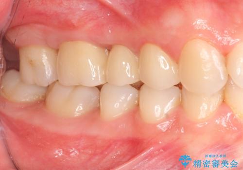 [深い虫歯] 根管治療・歯周外科治療を行い歯を保存するの治療後