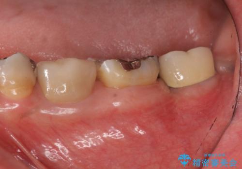 歯の破折による抜歯　インプラントによる咬合機能回復の症例 治療後