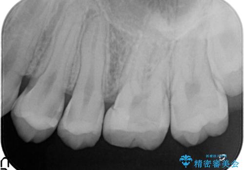 精密なむし歯の治療 セラミックインレーの治療前